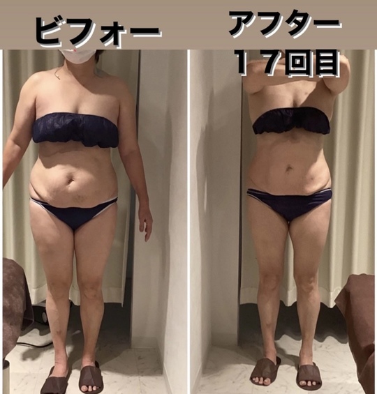 シェイプリフト　定価約30万　美容　痩身　ダイエット 千葉市若葉区の痩身、脂肪を減らし体を細くしたいなら希楽鍼灸